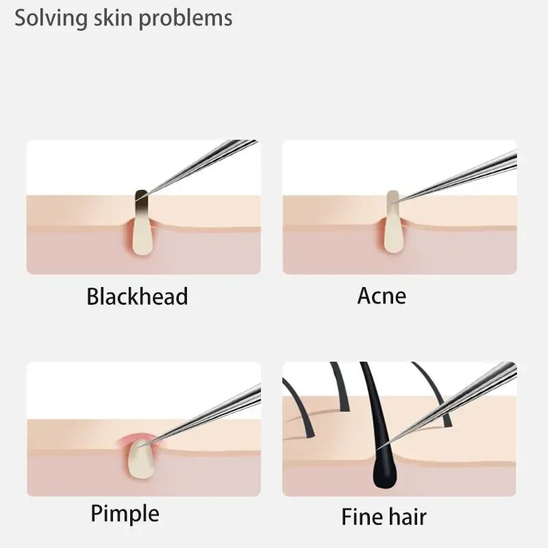 11Pcs Acne Pimple / Blackhead Remover