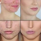 Acne Treatment Tree Oil Essence