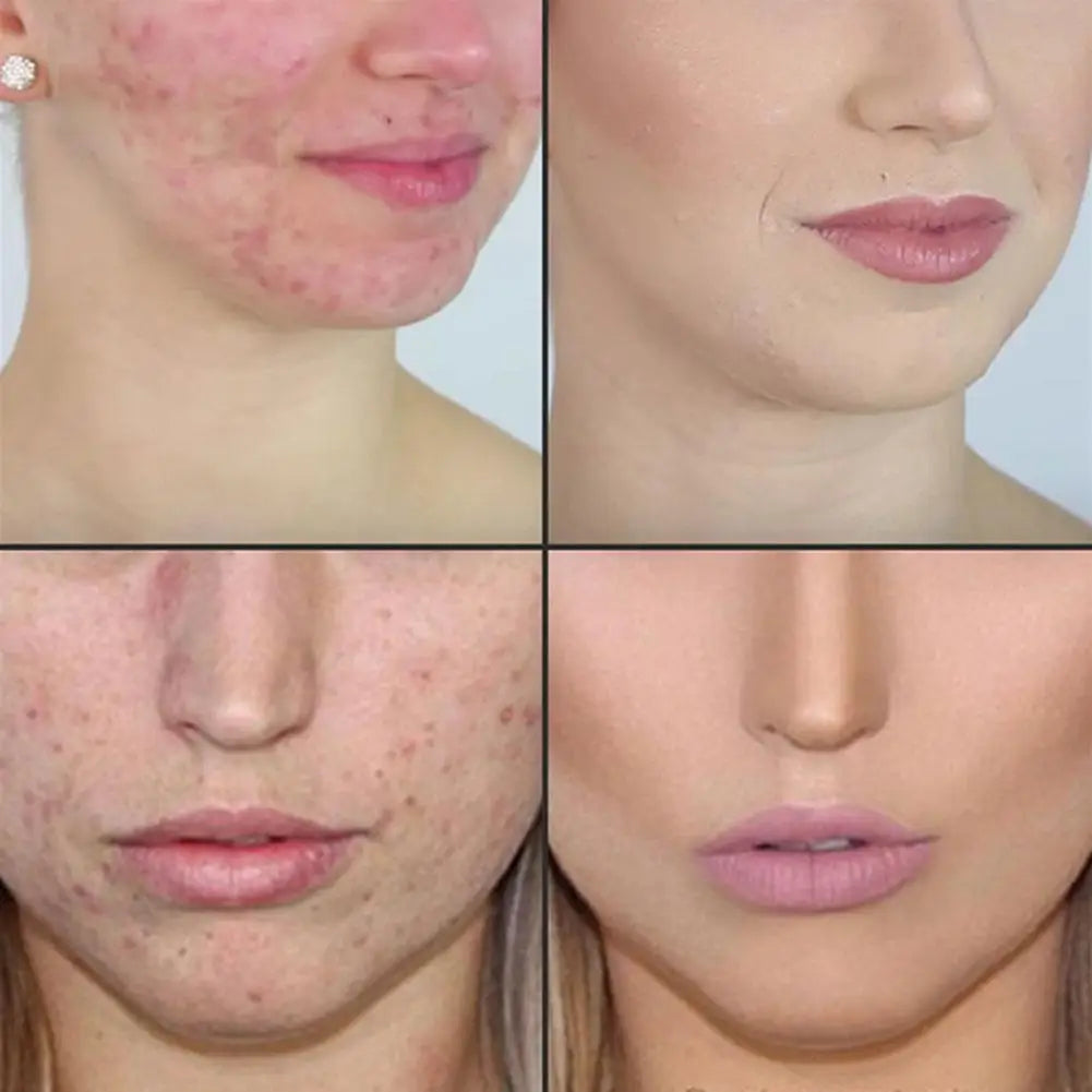 Acne Treatment Tree Oil Essence